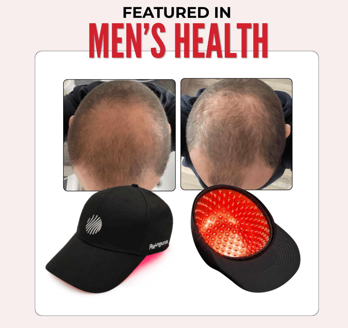 Hair thinning before and after results using laser therapy hair growth cap